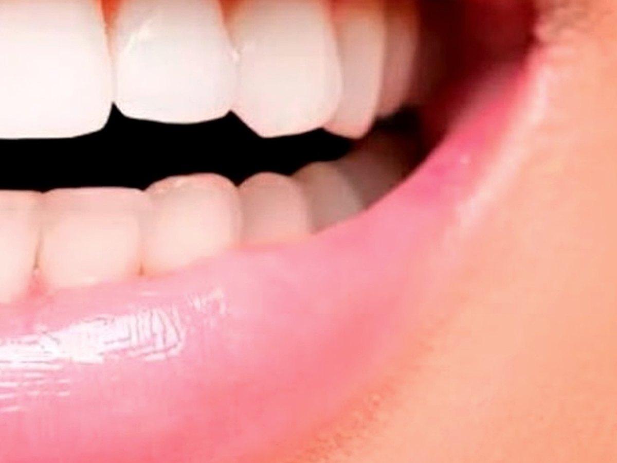 Blanqueamiento dental