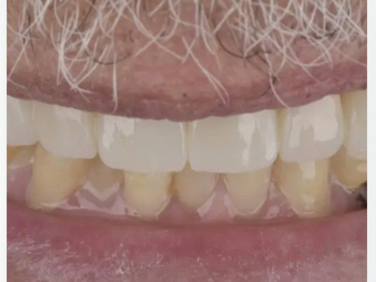 Blanqueamiento dental