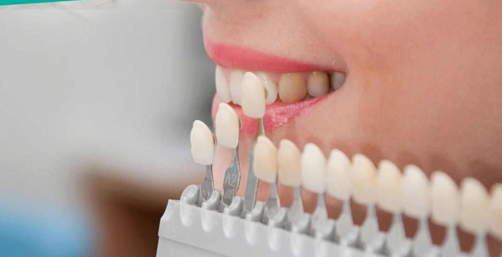 Carillas dentales