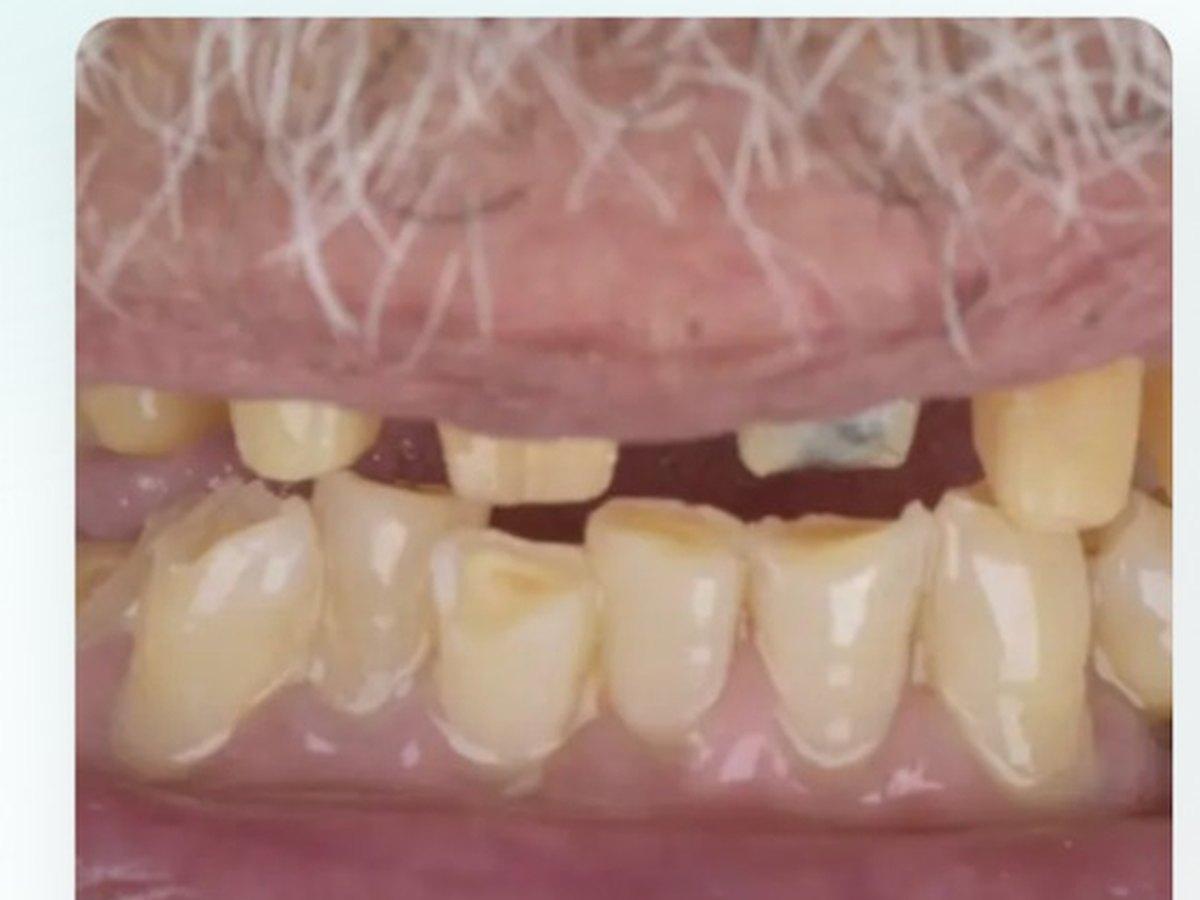 Carillas dentales